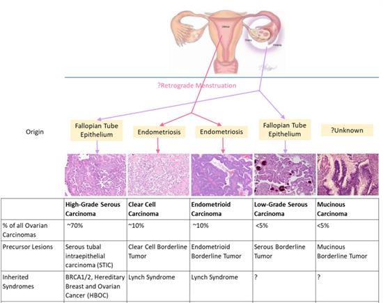 2-histological-classification-of-ovarian-carcinoma